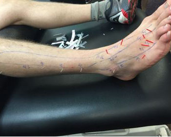 dry needling-2