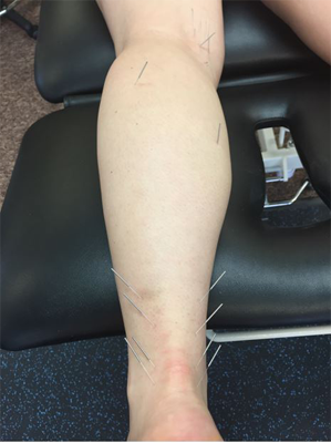 https://londonderrypt.com/wp-content/uploads/2017/06/dry-needling.png