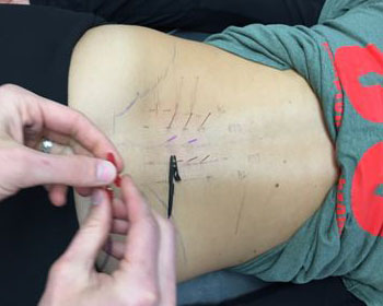 dry needling1