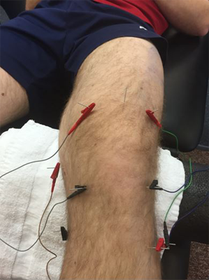 electro-dry-needling